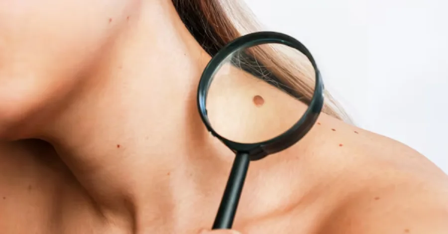 Mole Removal treatment