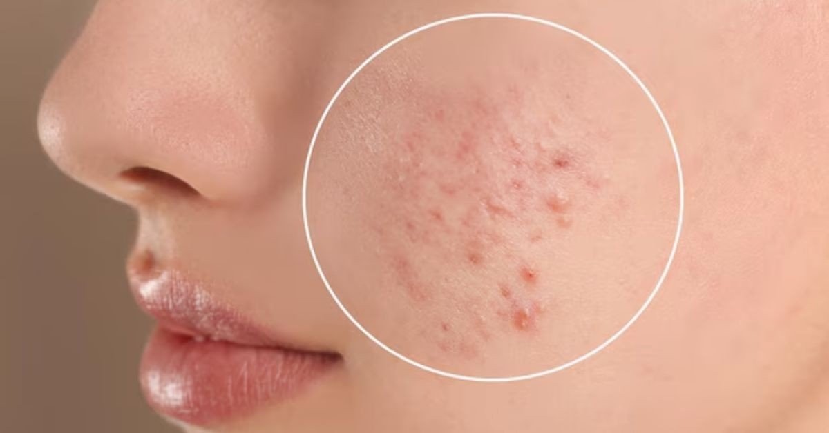 Acne Scars