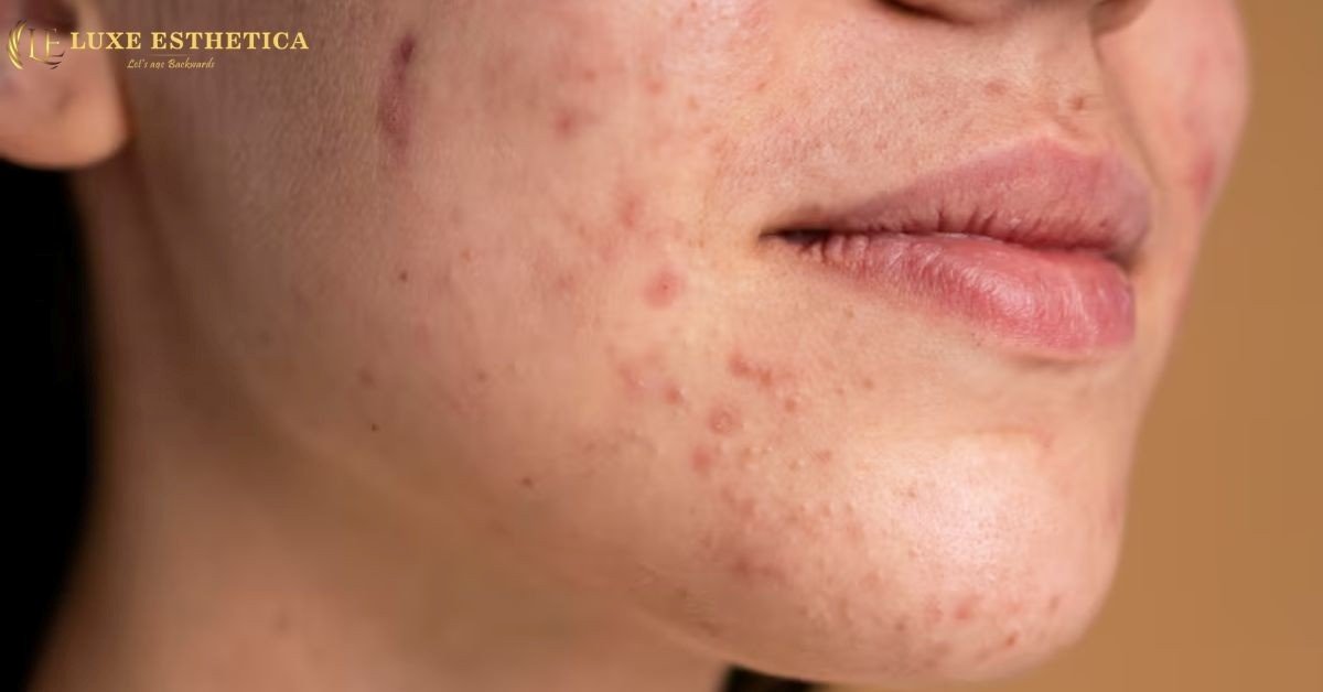 Scar treatment