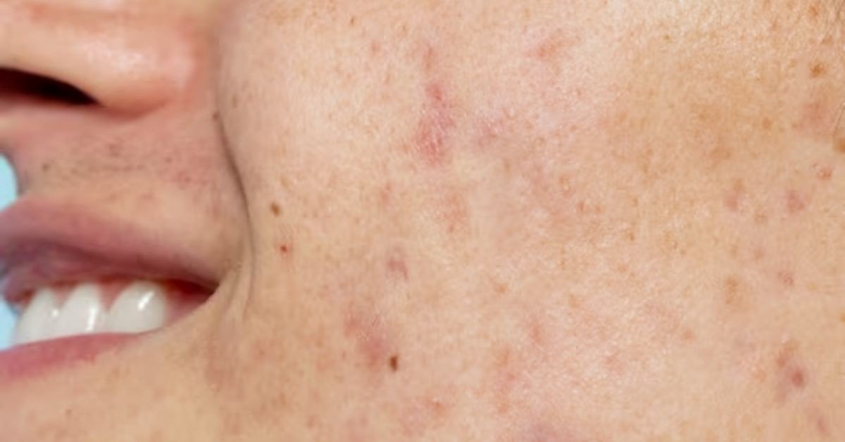 Scar Treatment
