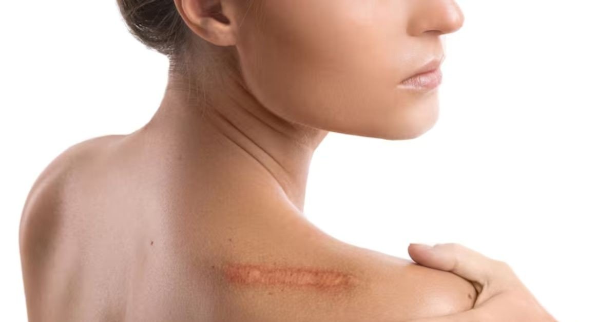 Surgical Scars